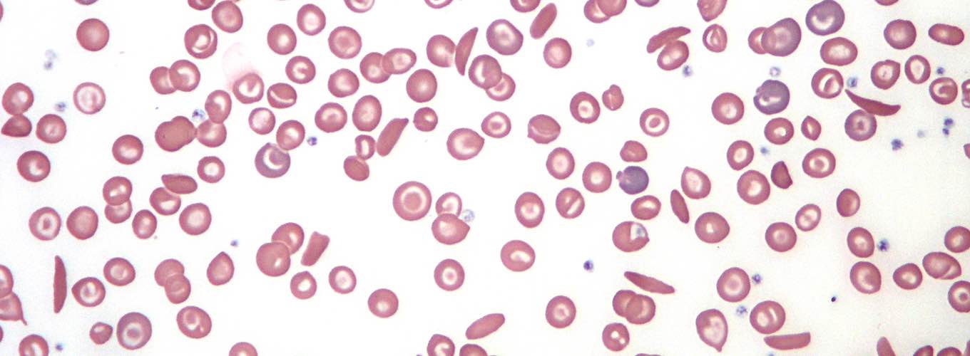 Frotis de anemia de células falciformes