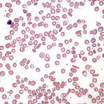 frotis de sangre de células falciformes