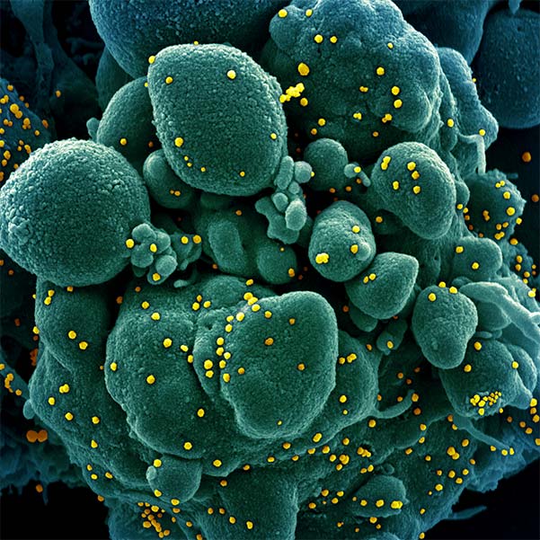 新型冠状病毒 SARS-CoV-2——感染 SARS-COV-2 病毒颗粒（黄色）的凋亡细胞（绿色）的彩色扫描电子显微照片
