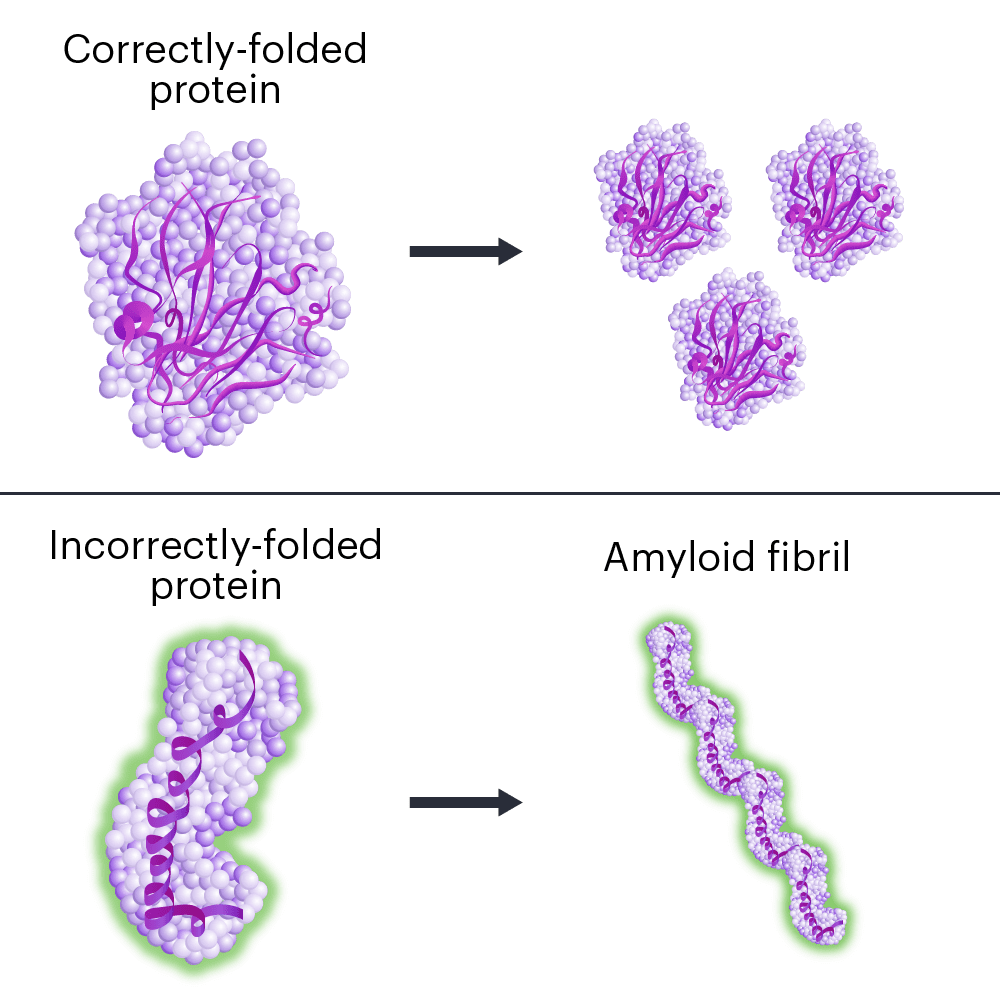 El proceso de amiloidosis, un objetivo actual para un ensayo clínico CRISPR