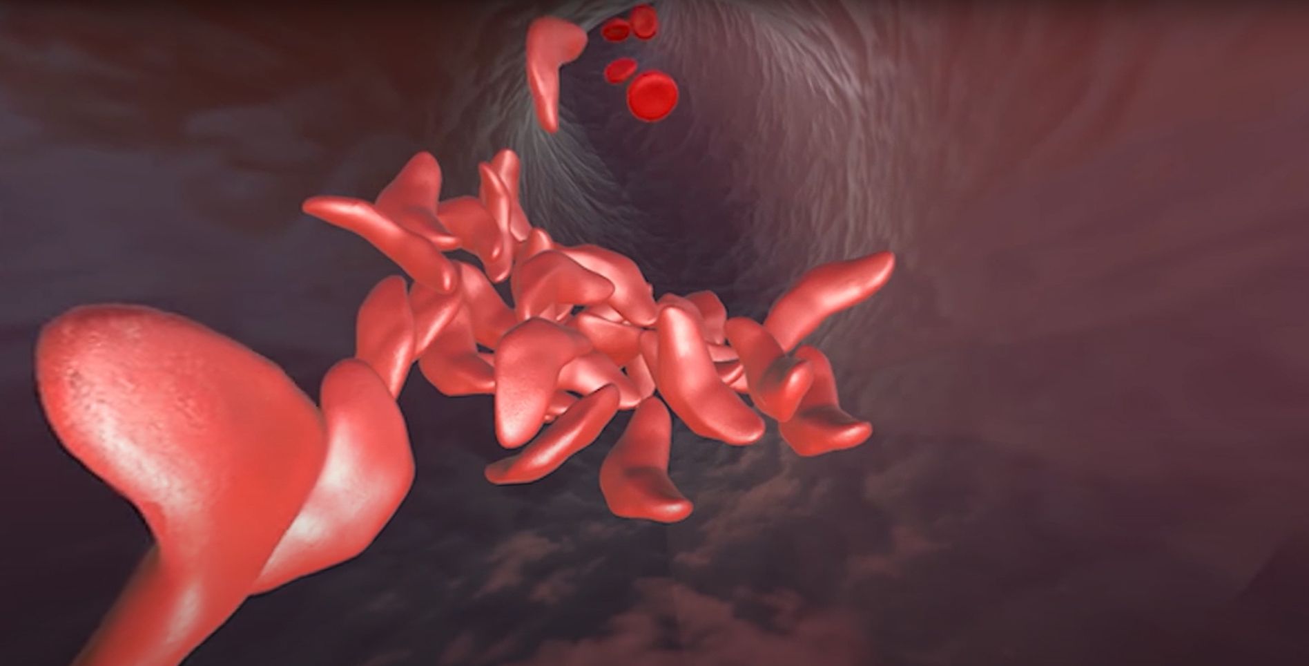 Terapia CRISPR para la anemia de células falciformes. Ilustración de la anemia de células falciformes con glóbulos rojos afectados en un vaso sanguíneo