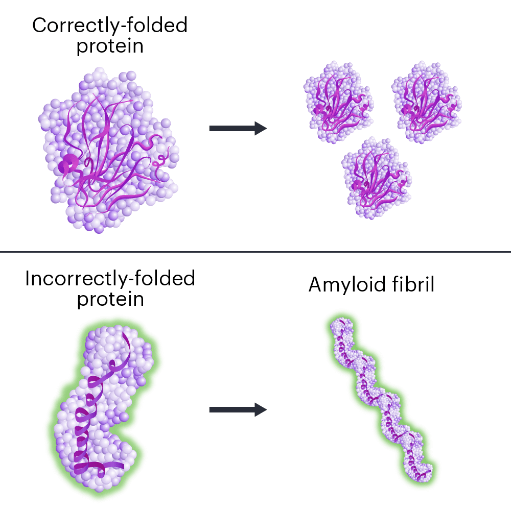 The process of amyloidosis, a current target for a CRISPR clinical trial