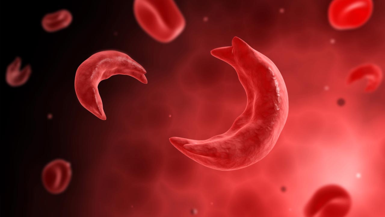 Sickle cells