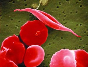 electron micrograph of a sickled red blood cell next to healthy round red blood cells