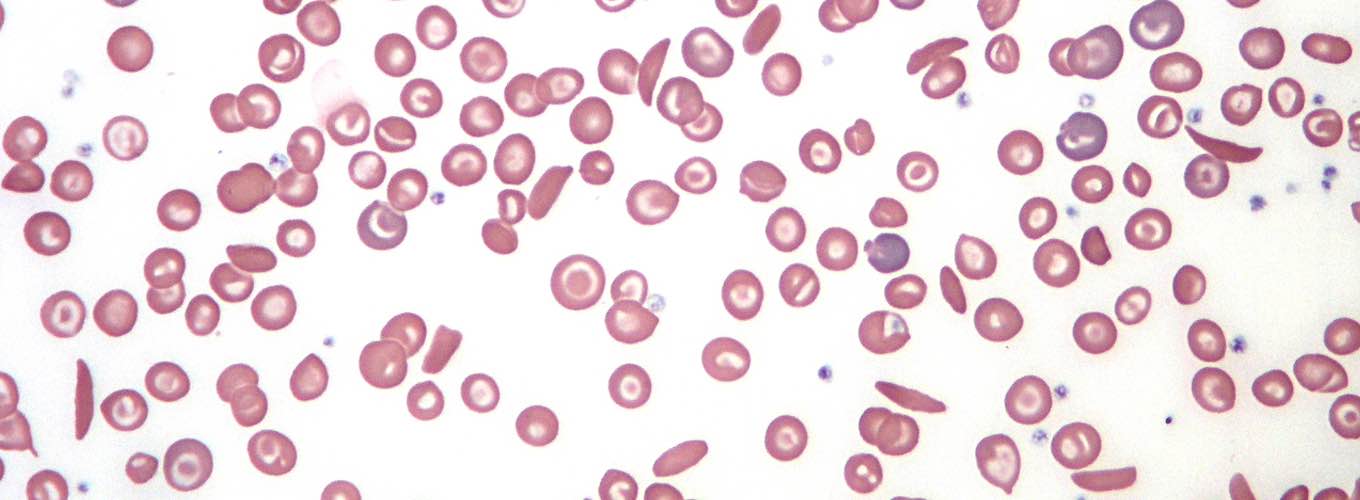 Sickle cell disease smear