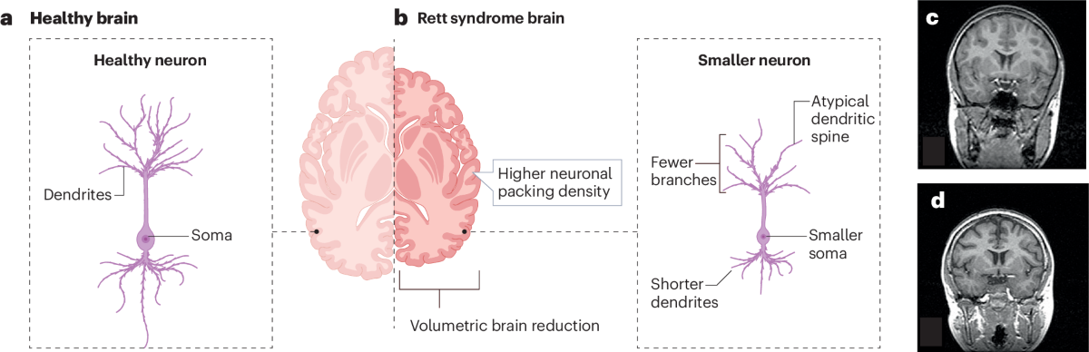 illustrations showing brain differences in Rett syndrome, including reduced brain volume and shorter neurons